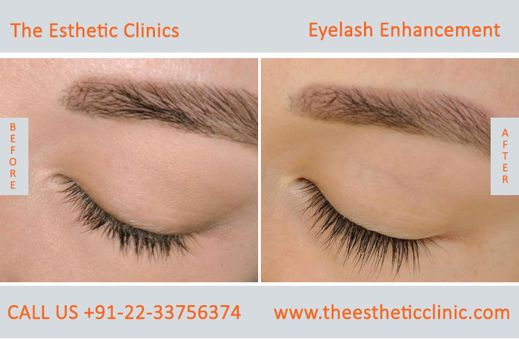 Eyelash Enhancement Surgery, Latisse Eyelash Treatment before after photos in mumbai india (1)